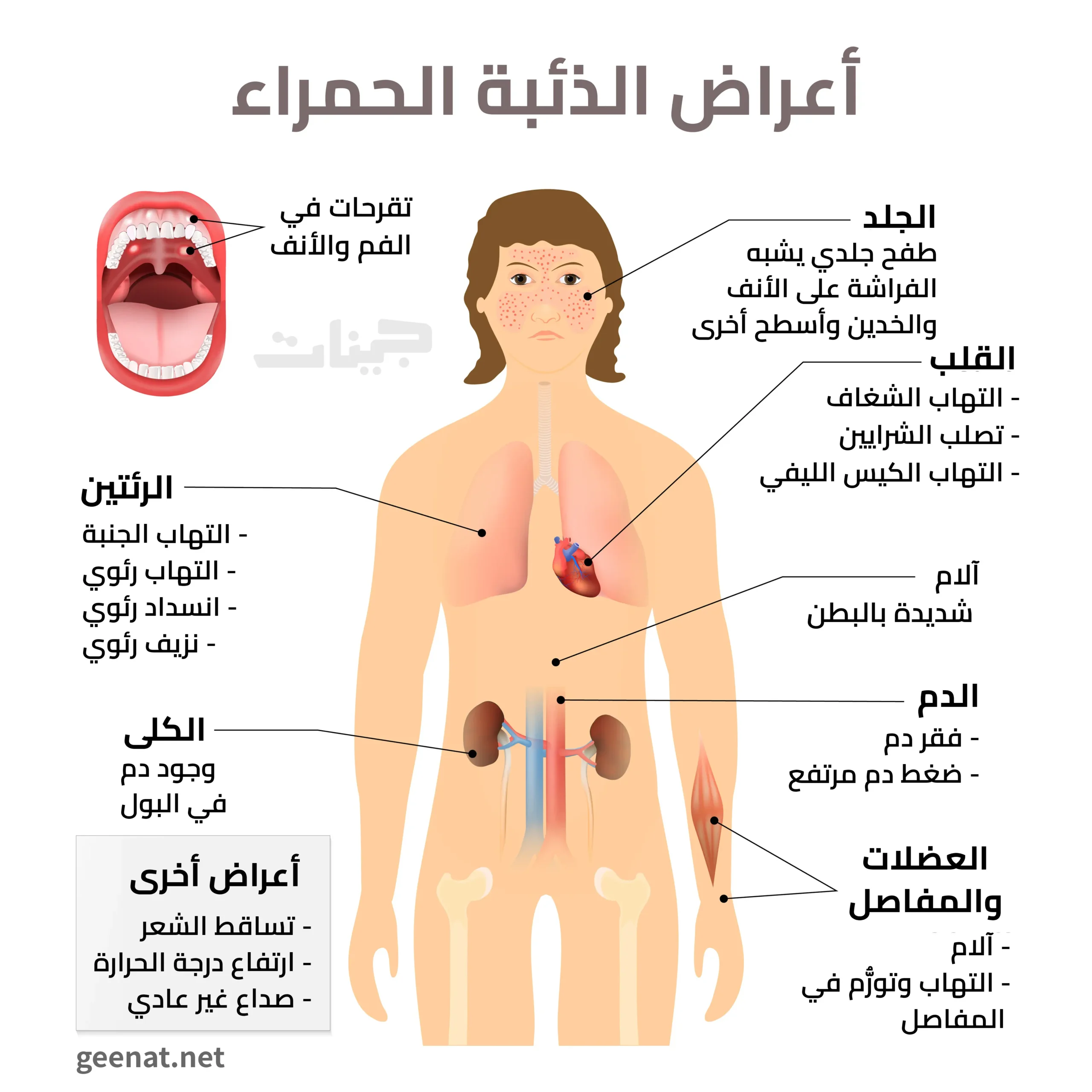 أعراض الذئبة الحمراء