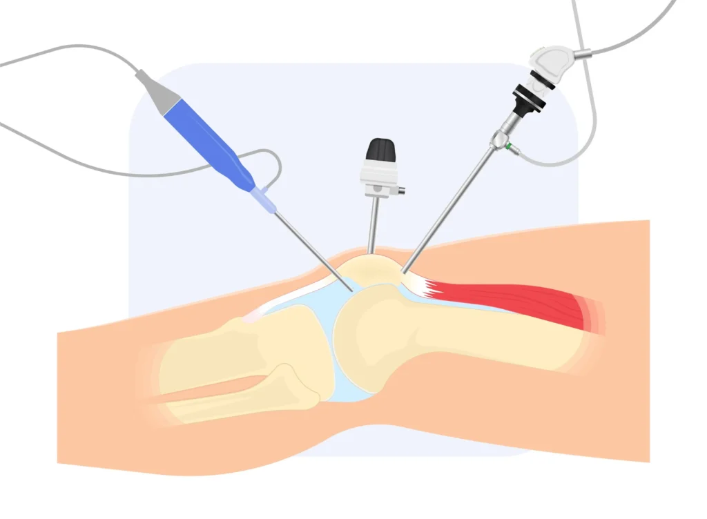 صورة توضيحية لتنظير مفصل الركبة (Arthroscopy) التي تدخل في علاج الرباط الصليبي الأمامي
