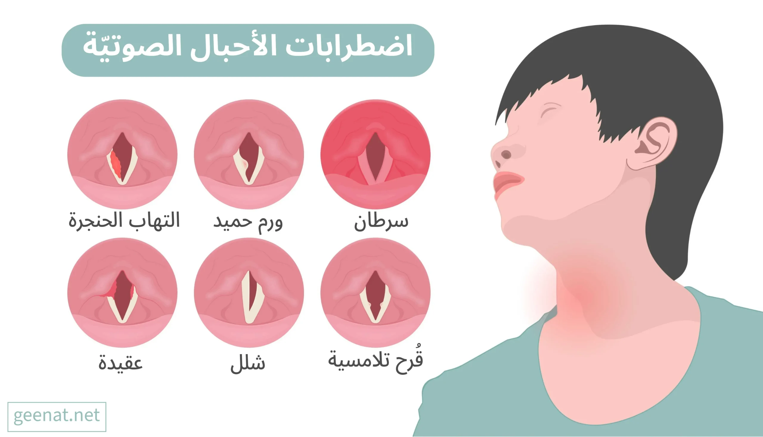 انفوجراف يبيّن الأمراض التي يمكن أن تصيب الأحبال الصوتية