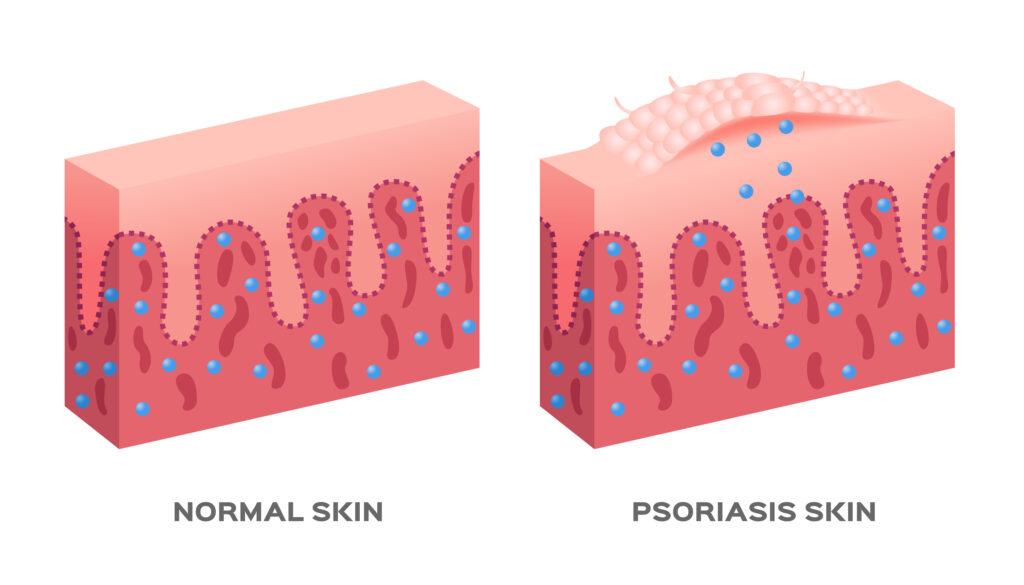 An illustration comparing normal skin with skin affected by psoriasis