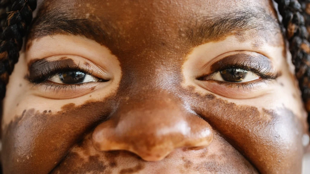 A woman with vitiligo, which is an incurable disease