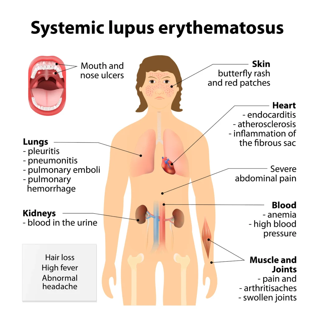 Lupus symptoms - infographic 